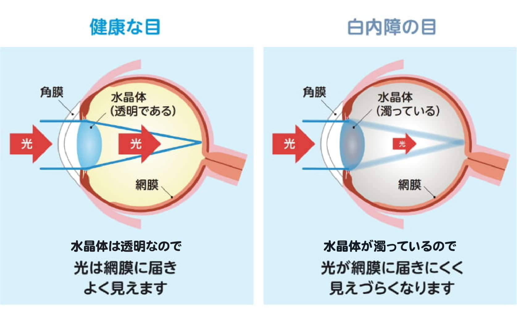 白内障とは