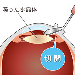 白内障の手術の手順 切開