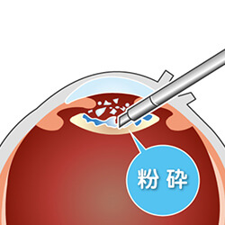 白内障の手術の手順 粉砕