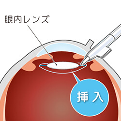 白内障の手術の手順 挿入